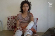 الصورة لطفلة اصيبت بقصف المليشيات قرية الشقب بتعز