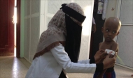 سوء التغذية يدق ناقوس المجاعة في اليمن